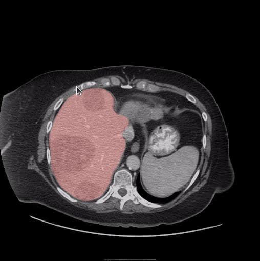 CT slice 1 with organ regions segmented and colour-coded
