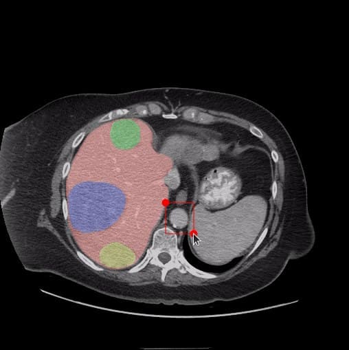 CT slice 2 with organ regions segmented and colour-coded